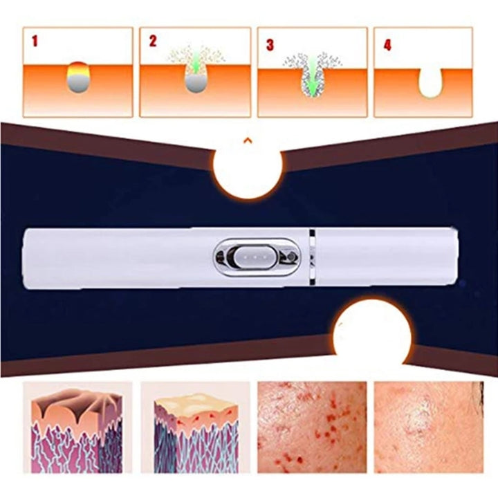 K-SKIN KD-7910 Acne Laser Pen Portable Wrinkle Removal Machine Durable Soft Scar Remover Device Blue Light Therapy Pen